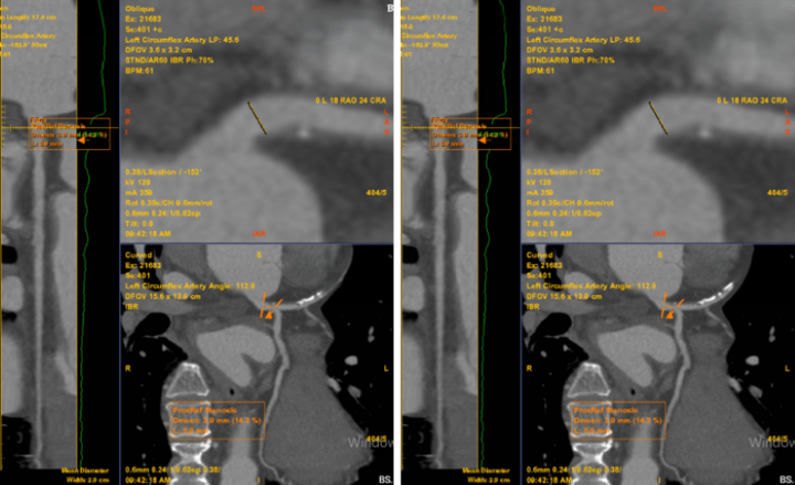 Bất thường được phát hiện trên phim chụp MSCT mạch vành của bệnh nhân (Ảnh: Medlatec).