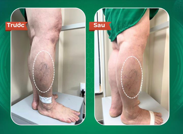 Hồi phục sau điều trị giãn tĩnh mạch tại Dr.Vein - 1
