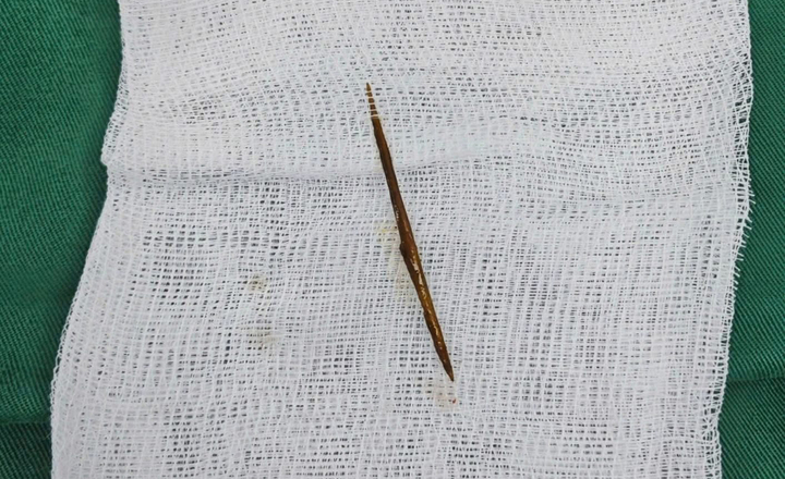 Bác sĩ khuyến cáo không nên ngậm tăm vì vô cùng nguy hiểm.