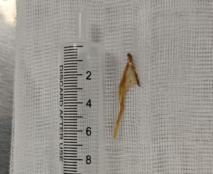 Xương gà dài 3cm mắc ở hậu môn của bệnh nhân. (Ảnh: MEDLATEC).