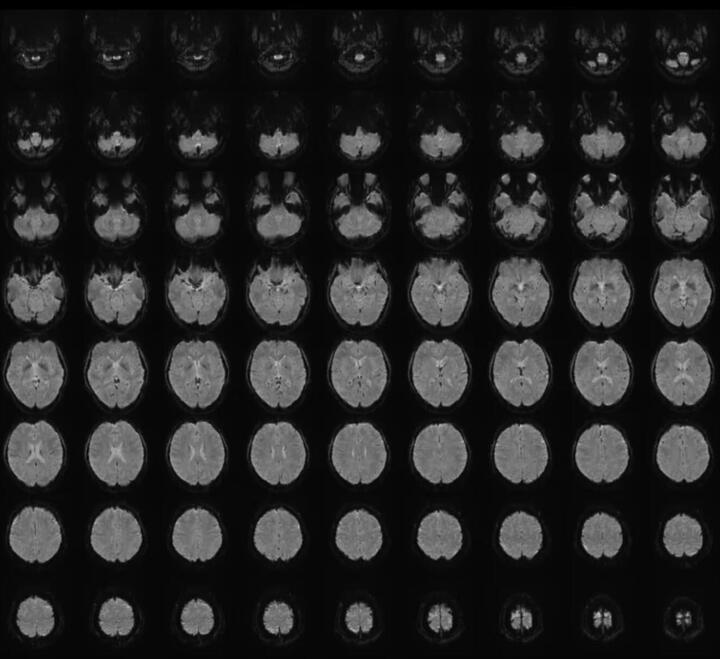 Chụp cộng hưởng từ chức năng (fMRI) là một kỹ thuật không xâm lấn dùng để đo hoạt động của não. (Ảnh: CNN)