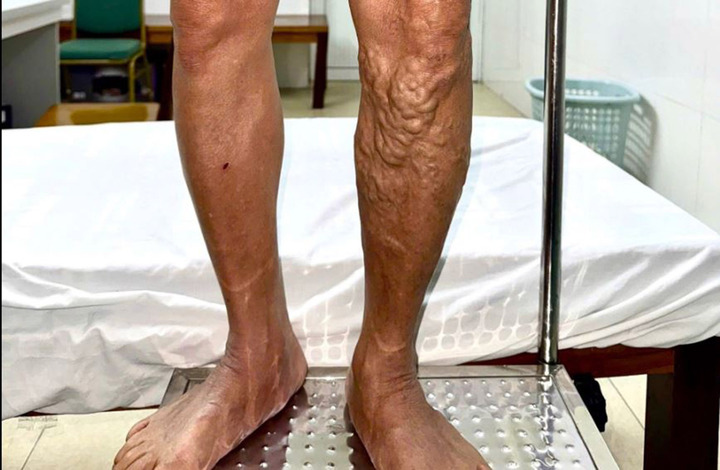 Chân nam bệnh nhân bỗng nổi chi chít 'sợi dây thừng' ngoằn ngoèo (Ảnh: BVCC).