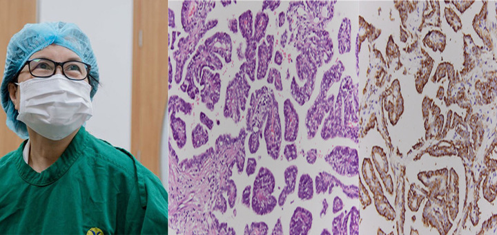 PGS.TS Hoàng Thị Phượng chỉ định sinh thiết khối u, phát hiện bệnh nhân mắc ung thư biểu mô tuyến nhú của phổi.