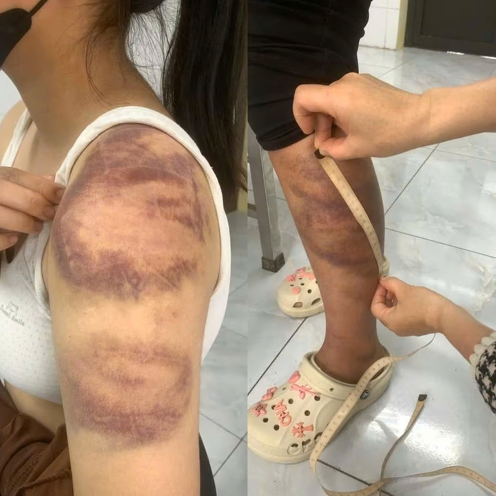 Những vết bầm tím trên cơ thể cháu T. do bị bố đẻ đánh. (Ảnh: Công an Bắc Ninh).