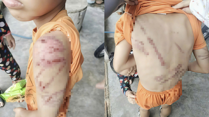 Hình ảnh thương tích trên người cháu bé.