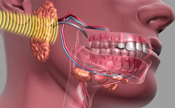 U xương hàm hiếm gặp nhưng có thể gây biến dạng khuôn mặt. (Ảnh minh hoạ)