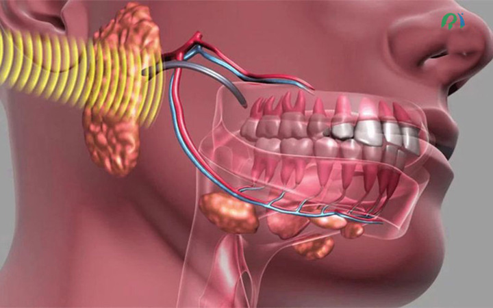 U xương hàm là một bệnh lý khá hiếm gặp (Ảnh: BV đa khoa Phương Đông).