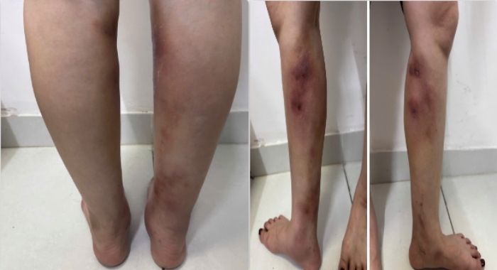 Cẳng chân biến dạng, xuất hiện nhiều khối sưng đỏ sau khi tiêm filler.