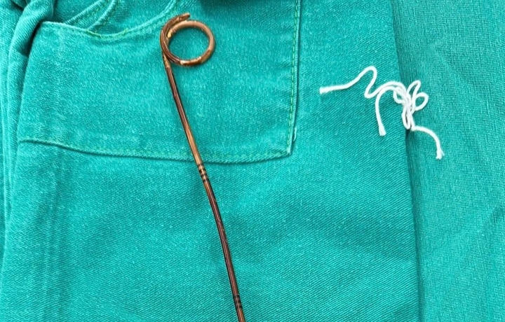 Ống sonde JJ được lấy ra ngoài.