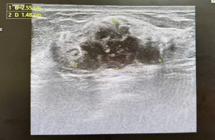 Hình ảnh khối u được phân loại BIRADS 4 trên siêu âm và chụp X-quang tuyến vú.