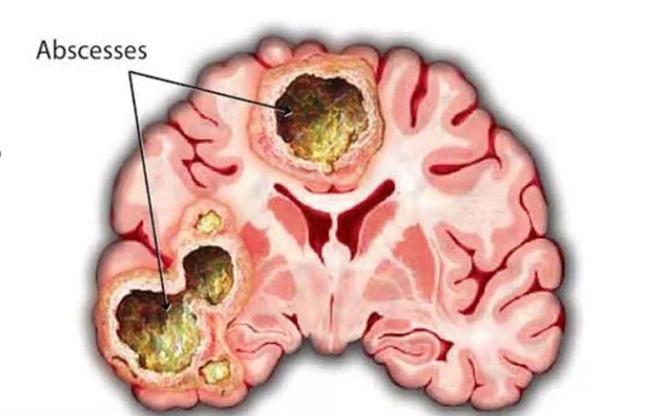 Áp xe não là tình trạng nhiễm trùng khu trú trong nhu mô não (Ảnh: BVCC)