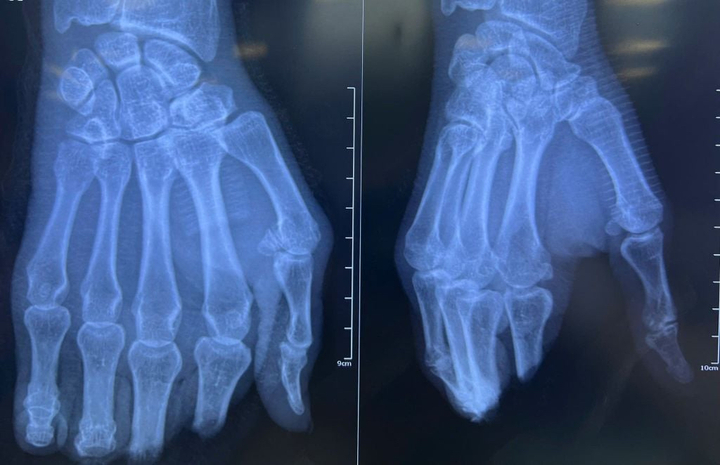 Hình chụp X-Quang bàn tay bị đứt lìa 4 ngón của người bệnh. (Ảnh: BVCC)