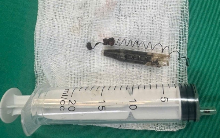 Hình ảnh dị vật sau khi được đưa ra khỏi vùng hố thái dương sau 13 năm.