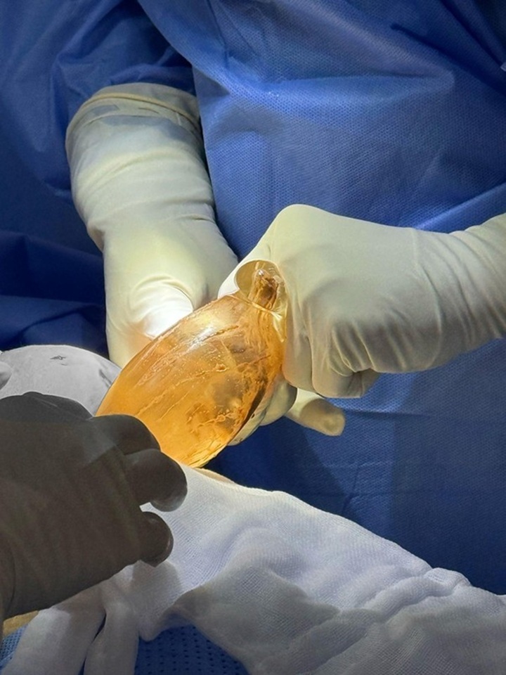 Nguyên nhân gây vỡ túi ngực sớm - 3