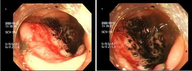 Ung thư trực tràng có thể diễn tiến âm thầm, khó nhận biết.