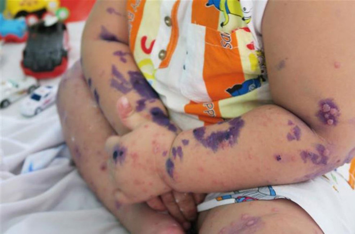 Gần 3.000 trẻ mắc chân tay miệng trong 2 tháng (Ảnh: Vietnamplus)