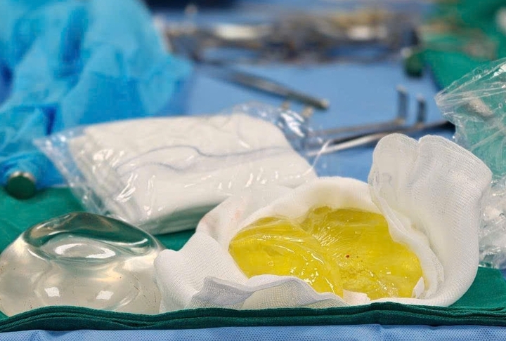 Bác sĩ phẫu thuật tháo túi, rửa sạch khoang ngực và đặt đòng túi ngực khác cho bệnh nhân. (Ảnh: BSCC)