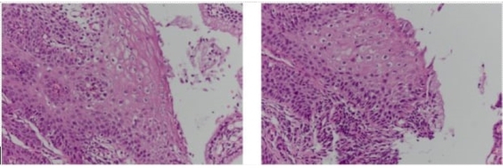 Tổn thương được phát hiện trên kết quả giải phẫu bệnh sinh thiết cổ tử cung.