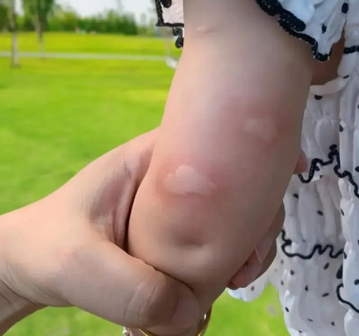 Trẻ em rất dễ bị muỗi đốt.