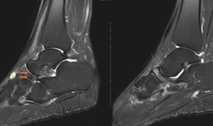 Hình ảnh chụp MRI cho thấy những dấu hiệu đặc trưng của Hội chứng Mueller-Weiss ở chân phải.