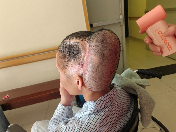 Sau phẫu thuật, bệnh nhân được túi giãn da vùng da đầu có tóc. (Ảnh: BVCC)