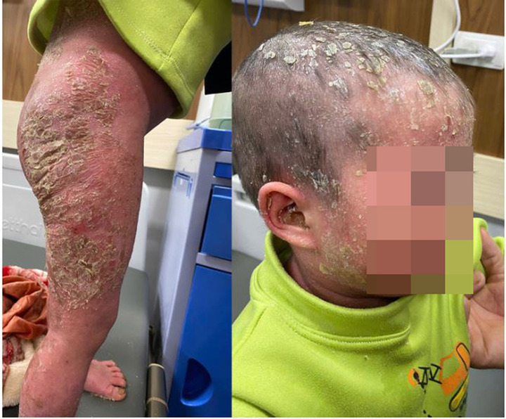 Những mảng da tróc vẩy khiến bé Hiền đau đớn.