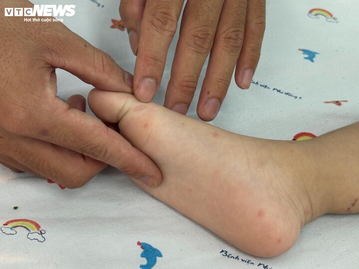 Chủng EV71 khiến ca tay ch&acirc;n miệng nặng tăng, TP.HCM dự ph&ograve;ng kịch bản qu&aacute; tải- Ảnh 2.