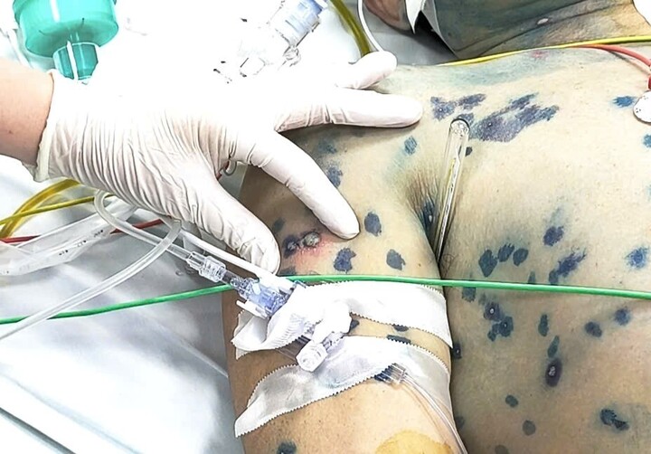 Người trưởng thành khi mắc thuỷ đậu có thể đối mặt với nhiều biến chứng nguy kịch. (Ảnh: Bộ Y tế)