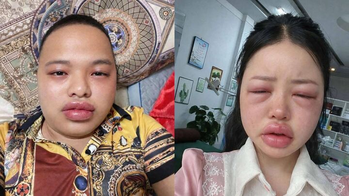 Là món ăn có hàm lượng đạm cao, nhiều bạn trẻ bị dị ứng ngay khi vừa thưởng thức. (Ảnh chụp màn hình)