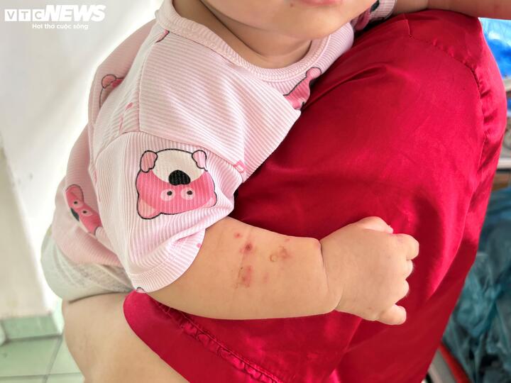 Bác sĩ kỳ vọng sớm có vaccine phòng bệnh tay chân miệng để giảm các ca bệnh nặng, chống lại biến chứng nguy hiểm.