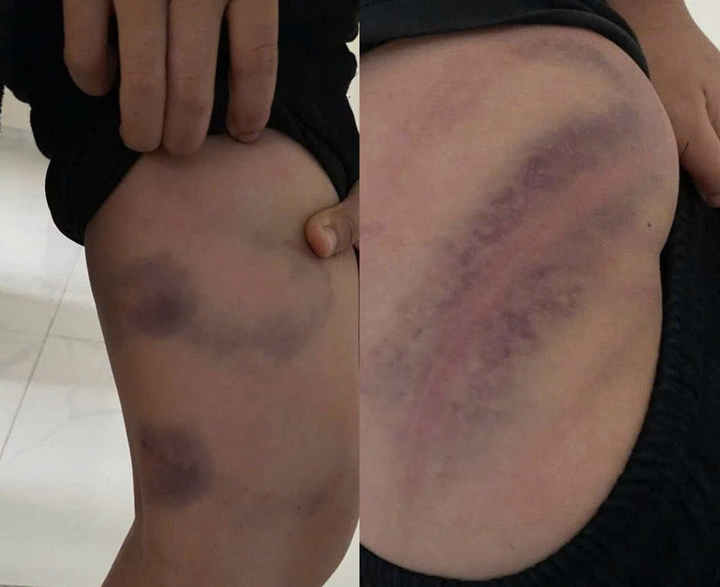 Hình ảnh vùng chân và mông của cháu Hiếu với nhiều vết thâm tím.