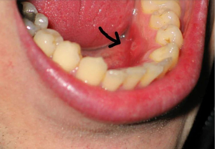 Ung thư khoang miệng triệu chứng dễ nhầm với nhiệt miệng (Ảnh minh họa)