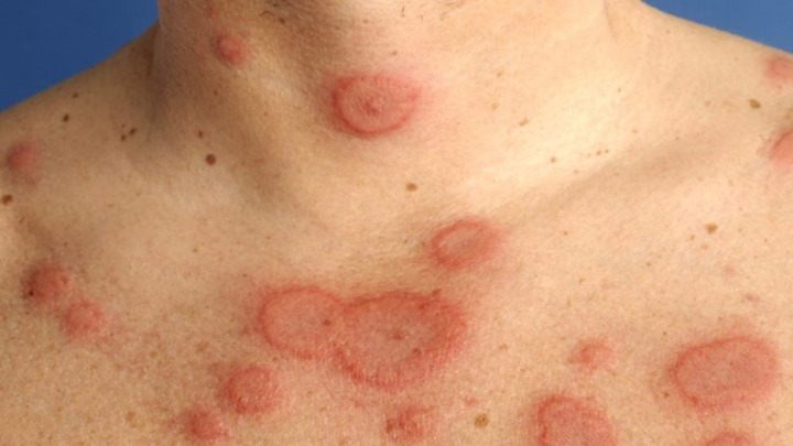 Rào cản lớn nhất của việc điều trị lupus nằm ở khâu chẩn đoán (Ảnh minh họa)