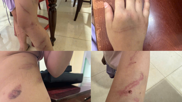 Những vết bầm trên người cháu bé.