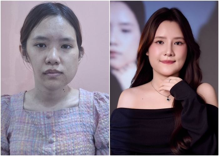 Bảo Ngọc trước và sau phẫu thuật.