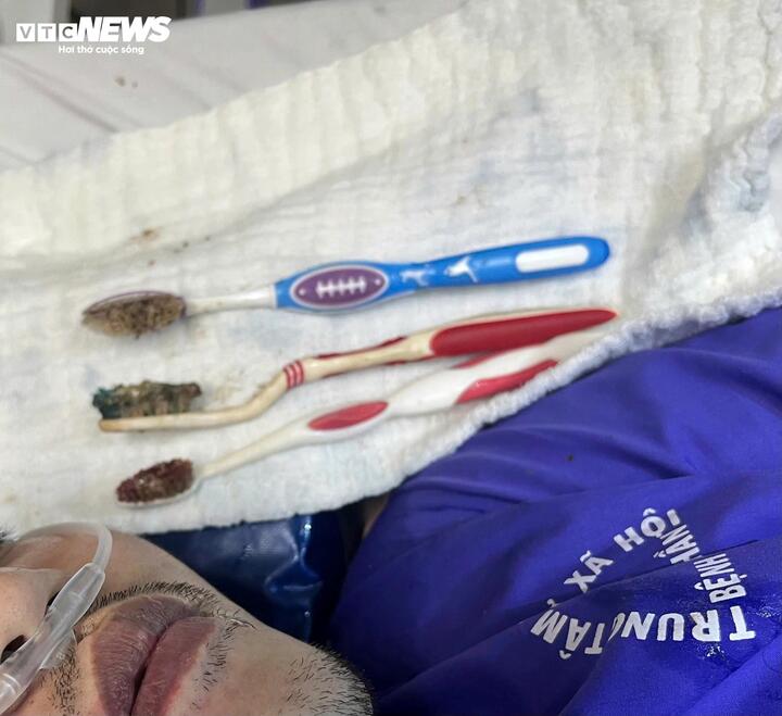 Dị vật là 3 chiếc bàn chải đánh răng được các bác sĩ can thiệp lấy ra khỏi cơ thể bệnh nhân