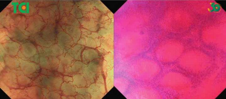 Tế bào quan sát dưới hệ thống nội soi Endocyto 520x.