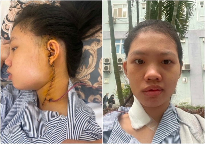 Sau phẫu thuật, Lan Anh đối mặt với di chứng liệt dây thần kinh số 7. (Ảnh: NVCC)