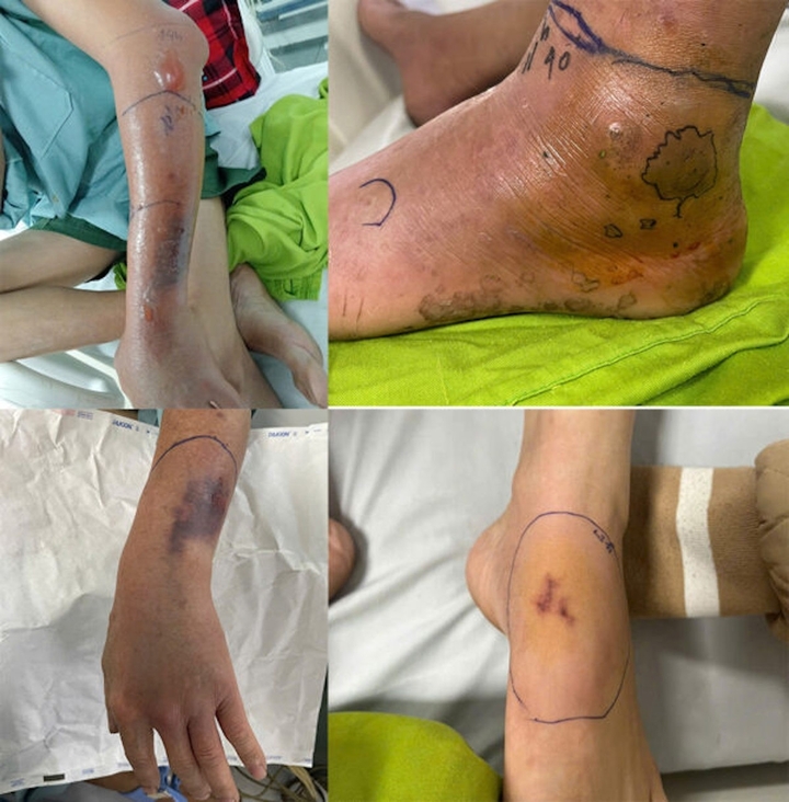 Những vết rắn cắn của nhiều bệnh nhân điều trị tại Bệnh viện đa khoa tỉnh Phú Thọ. (Ảnh: BVCC)