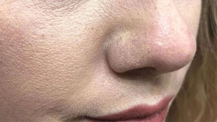 Để hạn chế kem chống nắng bị vón cục, nên cấp ẩm nhẹ trước khi thoa, đồng thời chờ các bước skincare thẩm thấu hoàn toàn để tránh xung đột giữa các lớp sản phẩm