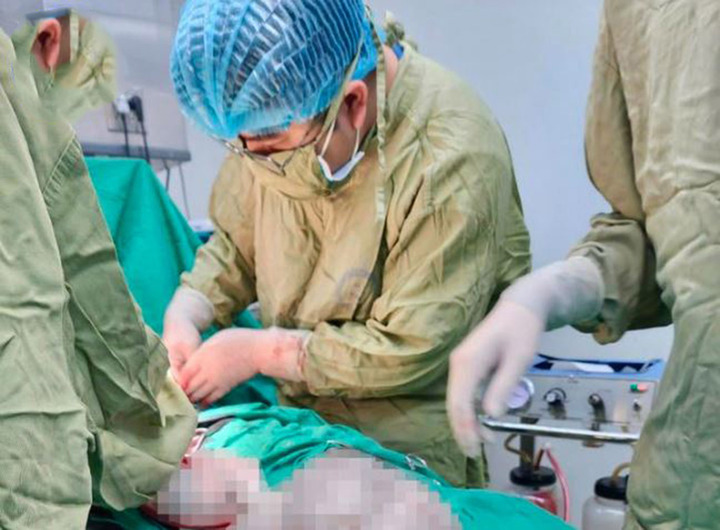 Các bác sĩ phẫu thuật lấy trọn khối u cho bệnh nhi. (Ảnh: BVPSTƯ)