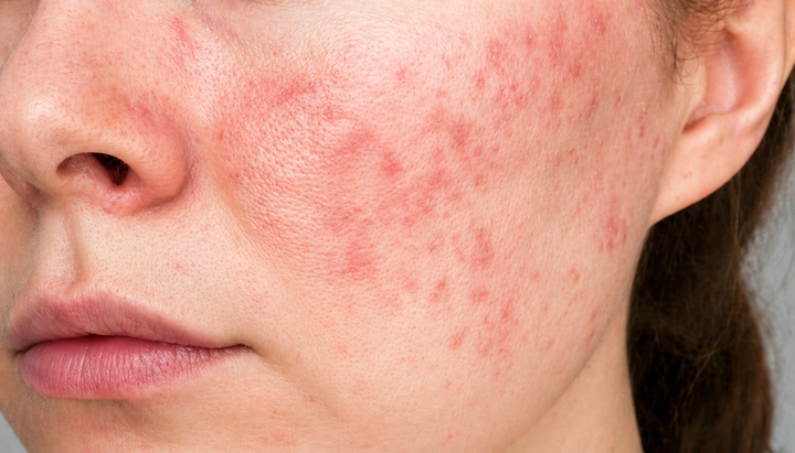 Bác sĩ khuyến cáo không nên tự ý sử dụng thuốc có chứa corticoid. (Ảnh minh hoạ)