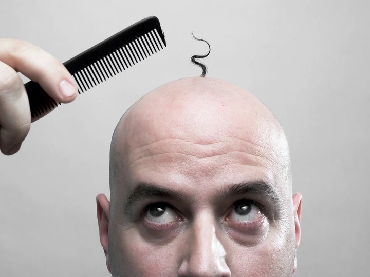 Tỷ lệ người hói đầu ở các châu lục có sự khác biệt rõ rệt. (Ảnh : iStock)