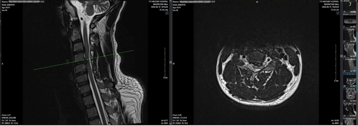 Kết quả chụp MRI cho thấy tụ máu ngoài màng cứng, trong ống sống cấp tính ngang mức c3->c5. (Ảnh: BVCC)