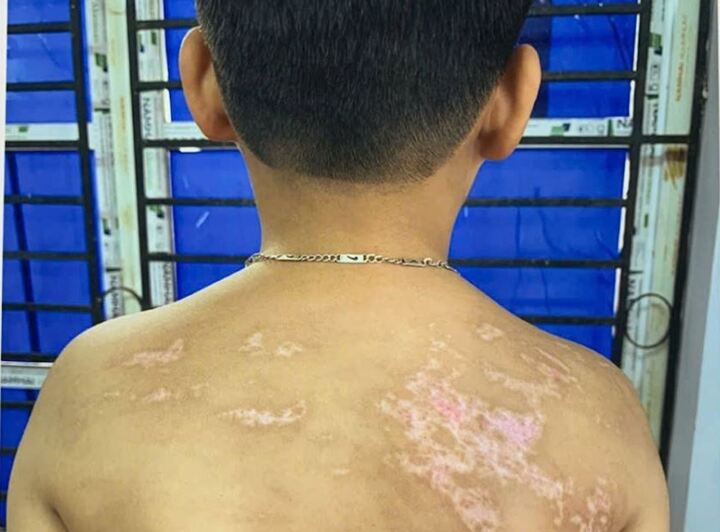 Những thương tích trên người cháu K.
