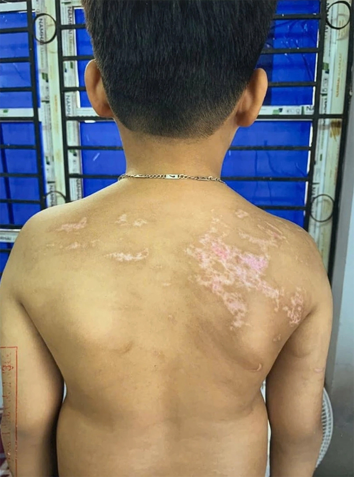 Những thương tích trên người cháu K., con trai Nguyễn Hà Chung.
