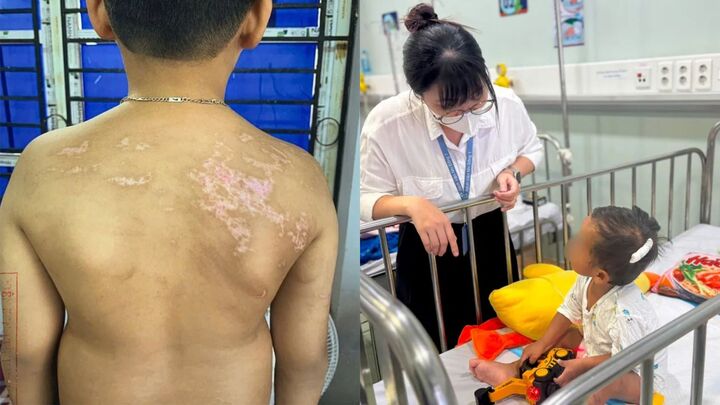 Những thương tích trên người cháu bị cha ruột Nguyễn Hà Chung bạo hành và hình ảnh cháu bé K. (18 tháng tuổi) hồi phục trong Bệnh viện Nhi đồng 1 TP.HCM