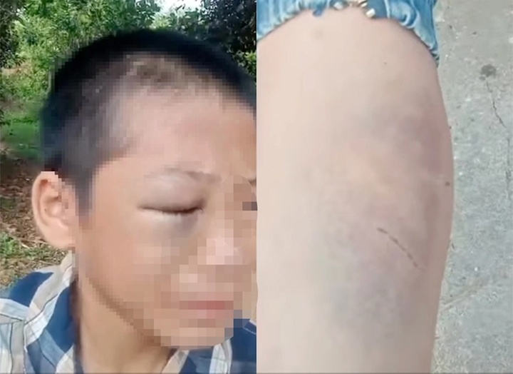 Hình ảnh cháu T. bị đánh bầm tím được chia sẻ trên mạng xã hội