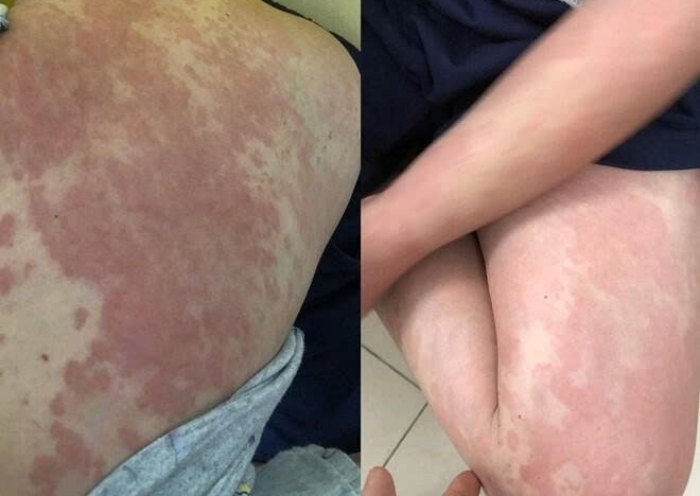 Vùng cổ, lưng và hai cánh tay của cô gái xuất hiện dày đặc nốt đỏ. (Ảnh: BSCC)