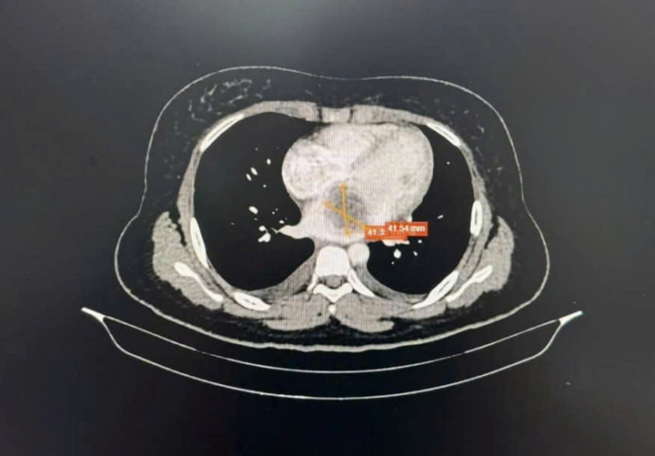 Hình ảnh khối u qua phim chụp CT.